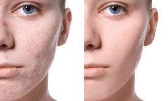 Spa trị sẹo rỗ do mụn uy tín nhất tại Hải Phòng