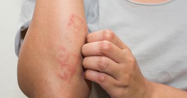 Hiểu biết cơ bản nhất về bệnh chàm