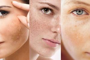 Spa trị nám tốt nhất tỉnh Ninh Bình