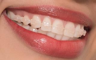 Nha khoa niềng răng mắc cài sứ dây trong uy tín nhất Hải Phòng