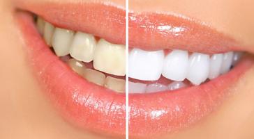 Địa chỉ tẩy trắng răng uy tín nhất TP. Pleiku, Gia Lai