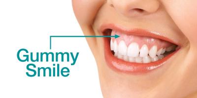 Địa chỉ chữa cười hở lợi uy tín nhất Tp HCM