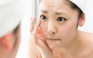 Mỹ phẩm trị mụn đang được ưa chuộng nhất hiện nay