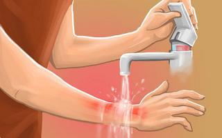 Cách trị bỏng tại nhà tốt nhất hiện nay