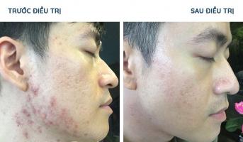 Spa trị sẹo rỗ do mụn tốt nhất Quảng Ngãi