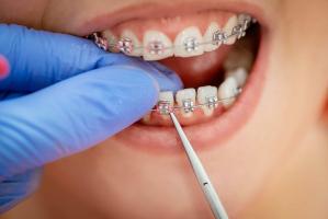 Điều cần biết về niềng răng mắc cài tự buộc