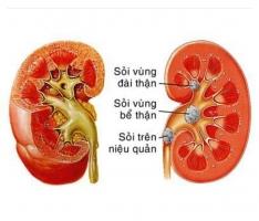Dấu hiệu bệnh sỏi thận bạn nên biết