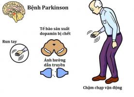 Địa chỉ khám và điều trị bệnh Parkinson tốt nhất Hà Nội