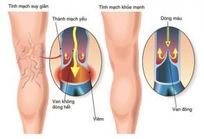 Địa chỉ khám và điều trị suy giãn tĩnh mạch uy tín nhất TP. Hồ Chí Minh