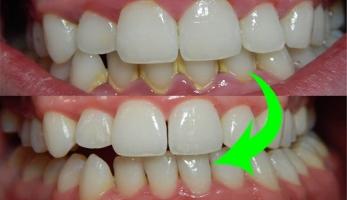 Địa chỉ lấy cao răng uy tín hàng đầu tại TP. HCM