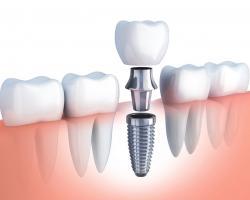 Địa chỉ trồng răng implant tốt nhất tỉnh Lâm Đồng