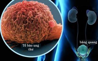 điều cần biết nhất về căn bệnh ung thư bàng quang