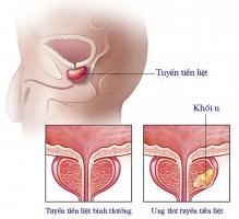 Điều cần biết nhất về ung thư tuyến tiền liệt