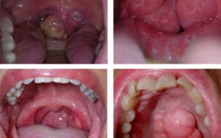 điều cần biết nhất về ung thư vòm họng