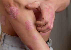 Kem bôi hỗ trợ điều trị bệnh vảy nến hiệu quả nhất hiện nay