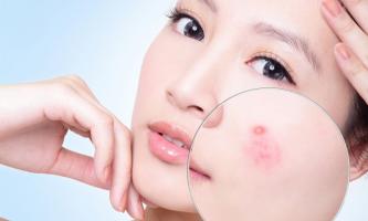 Địa chỉ nặn mụn chuẩn y khoa ở Vinh, Nghệ An nổi tiếng nhất