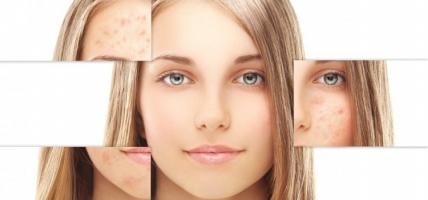 Loại kem trị nám da tốt nhất
