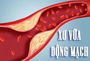 Lưu ý quan trọng nhất về bệnh xơ vữa động mạch