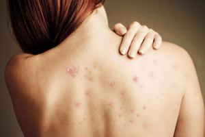 Nguyên nhân tiềm ẩn của mụn trứng cá và cách loại bỏ hiệu quả