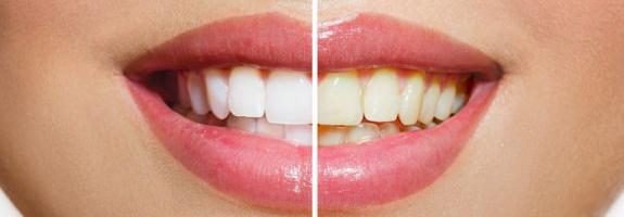 Địa chỉ tẩy trắng răng uy tín nhất tỉnh Đắk Nông