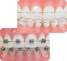 Địa chỉ niềng răng uy tín nhất tỉnh Phú Yên