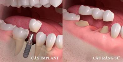 Địa chỉ trồng răng implant tốt nhất tỉnh Hà Tĩnh