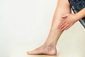 Sản phẩm điều trị giãn tĩnh mạch tốt nhất hiện nay