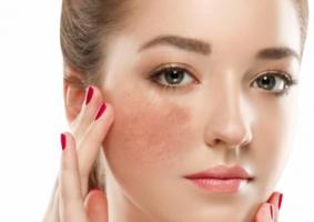 Sản phẩm huyết thanh trị nám hiệu quả nhất cho chị em