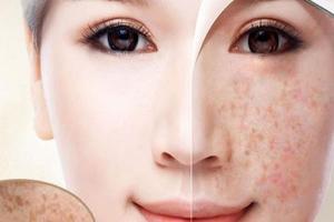 Spa trị nám tốt nhất TP. Đà Lạt, Lâm Đồng