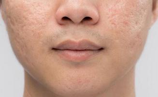 Spa trị sẹo rỗ do mụn tốt nhất Đà Lạt