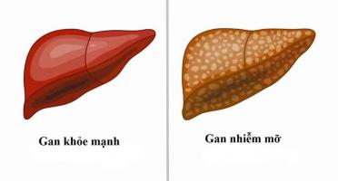 Thực phẩm chức năng tốt nhất hỗ trợ điều trị gan nhiễm mỡ