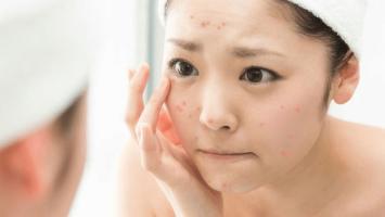 Địa chỉ nặn mụn chuẩn y khoa ở Quận 7, TP. HCM tốt nhất
