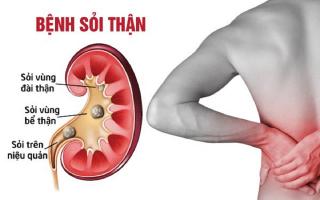 Điều cần biết về căn bệnh sỏi thận