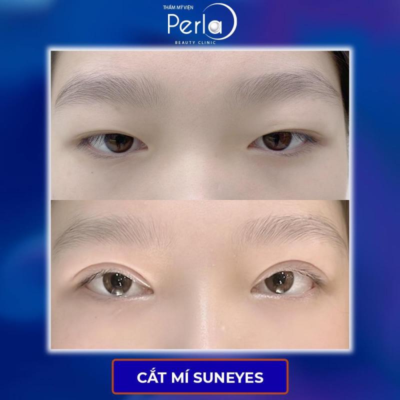Cắt mí Suneyes