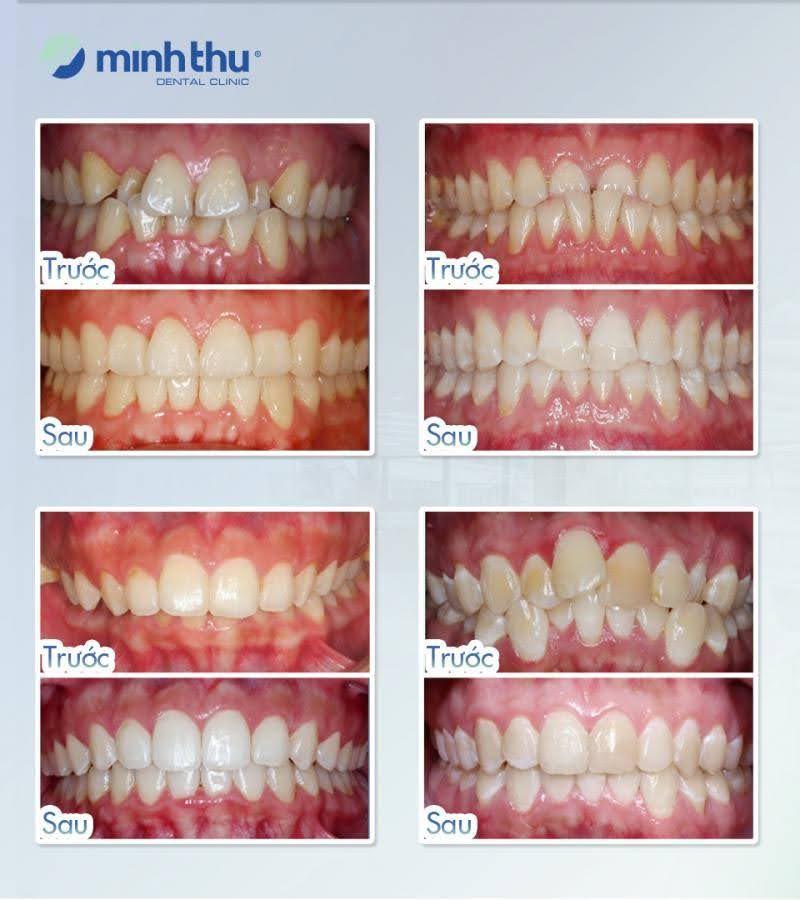 Các ca điều trị niềng kết thúc tại Minh Thu đều đạt được cả yếu tố thẩm mỹ, khả năng ăn nhai, khớp cắn đúng, và sự ổn định lâu dài cho bệnh nhân