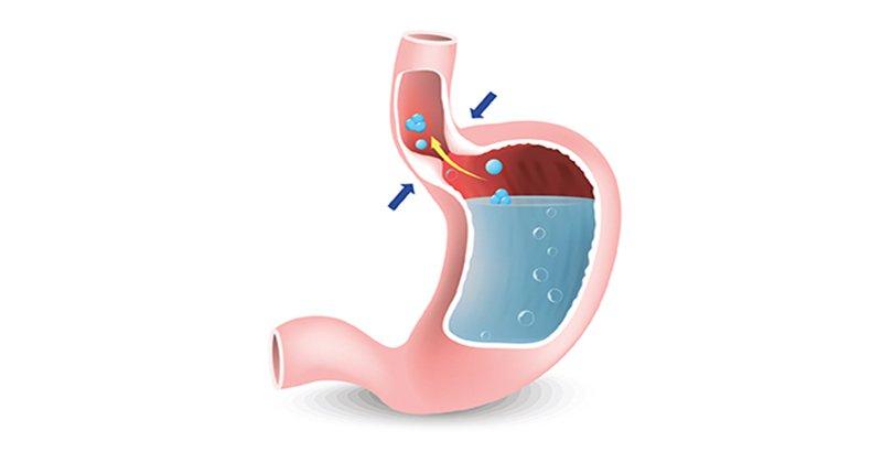 Bệnh co thắt tâm vị (Achalasia)