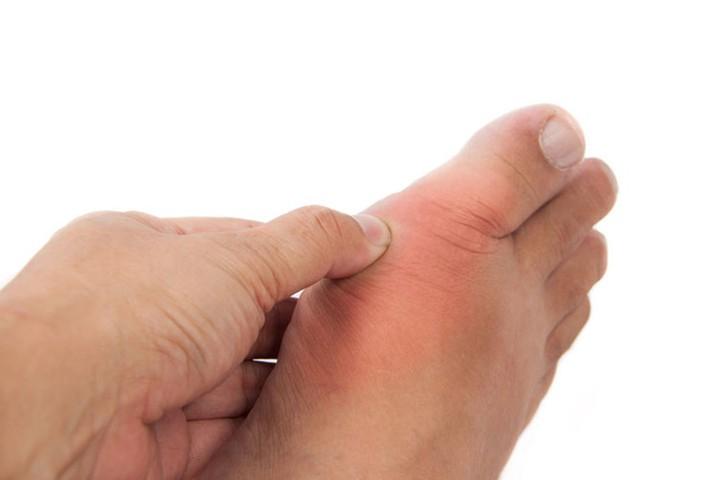 Bệnh Gout