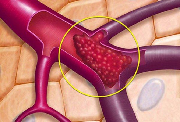 Tiếp xúc nhiều với máy tính có thể dẫn đến bệnh huyết khối