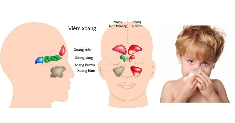 Bệnh viêm xoang ở trẻ