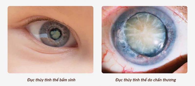 Đục thủy tinh thể bẩm sinh và do chấn thương