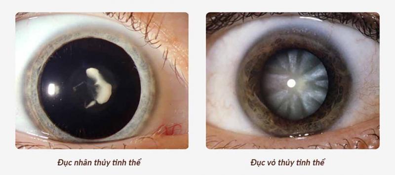 Đục nhân thủy tinh thể và đục vỏ thủy tinh thể