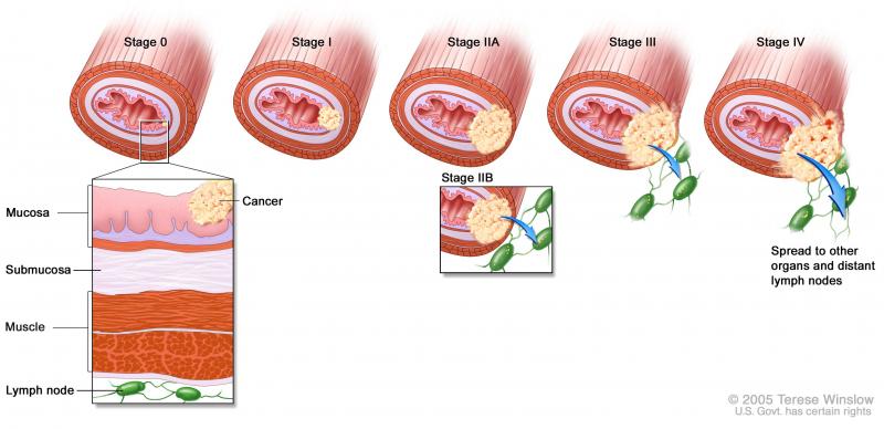 Các giai đoạn của ung thư thực quản