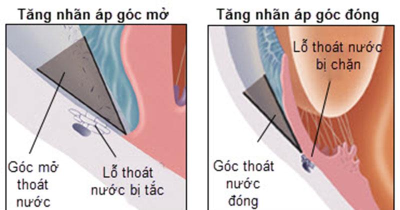 Tăng nhãn áp góc mở và tăng nhãn áp góc đóng