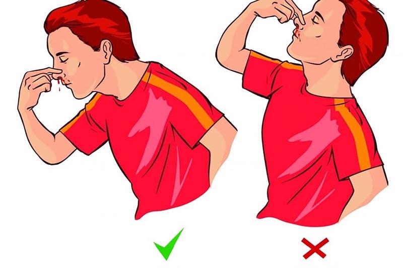 Khi bị chảy máu cam cần phải bóp chặt cánh mũi, đặt bệnh nhân ở tư thế ngồi thẳng, đầu hơi ngả về trước