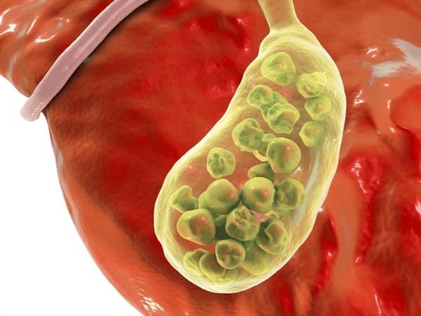 Hỗ trợ điều trị sỏi mật có bản chất là  cholesterol