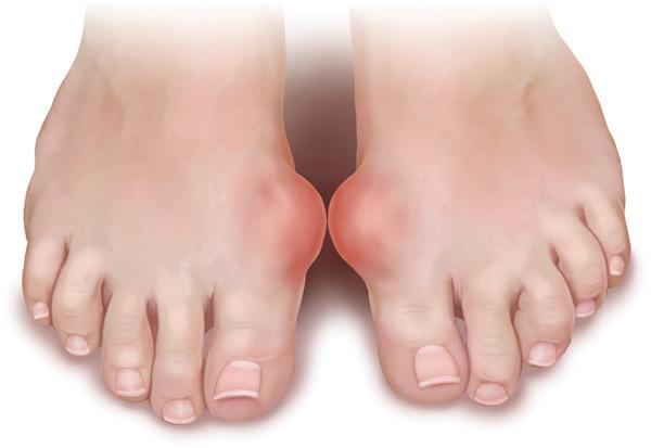Trong tía tô có tinh dầu giảm đau cho người bị gút
