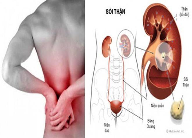 Rau diếp chữa bệnh sỏi thận