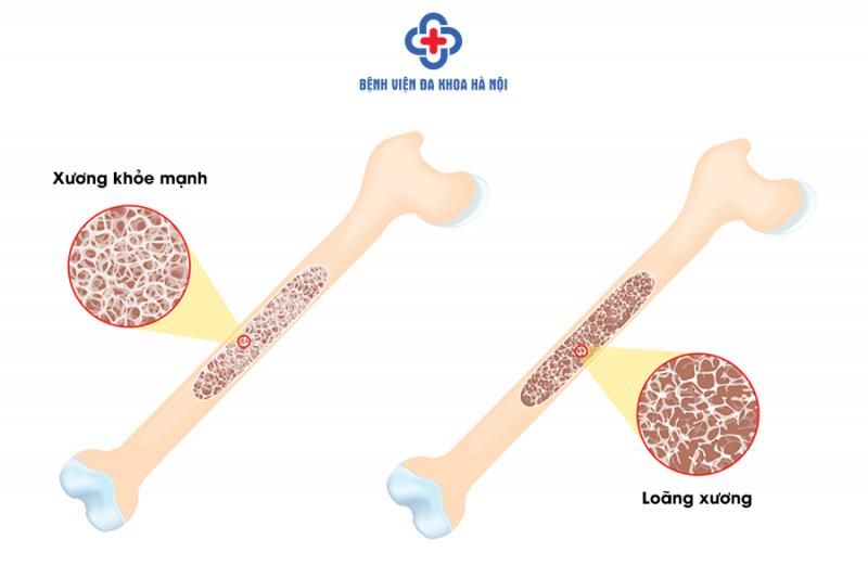 Chùm ngây phòng bệnh loãng xương