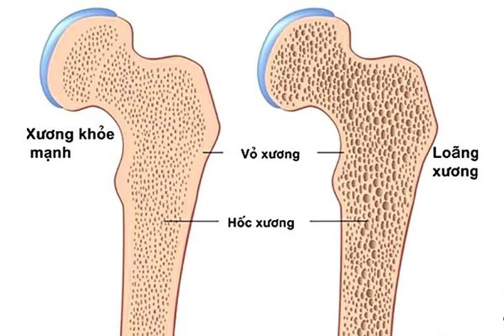 Bổ sung vitamin B12 ngừa loãng xương