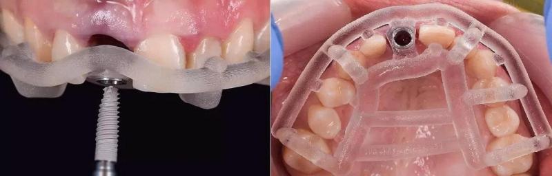 Máng hướng dẫn phẫu thuật được áp dụng thường quy tại LVI đảm bảo phẫu thuật chính xác, an toàn